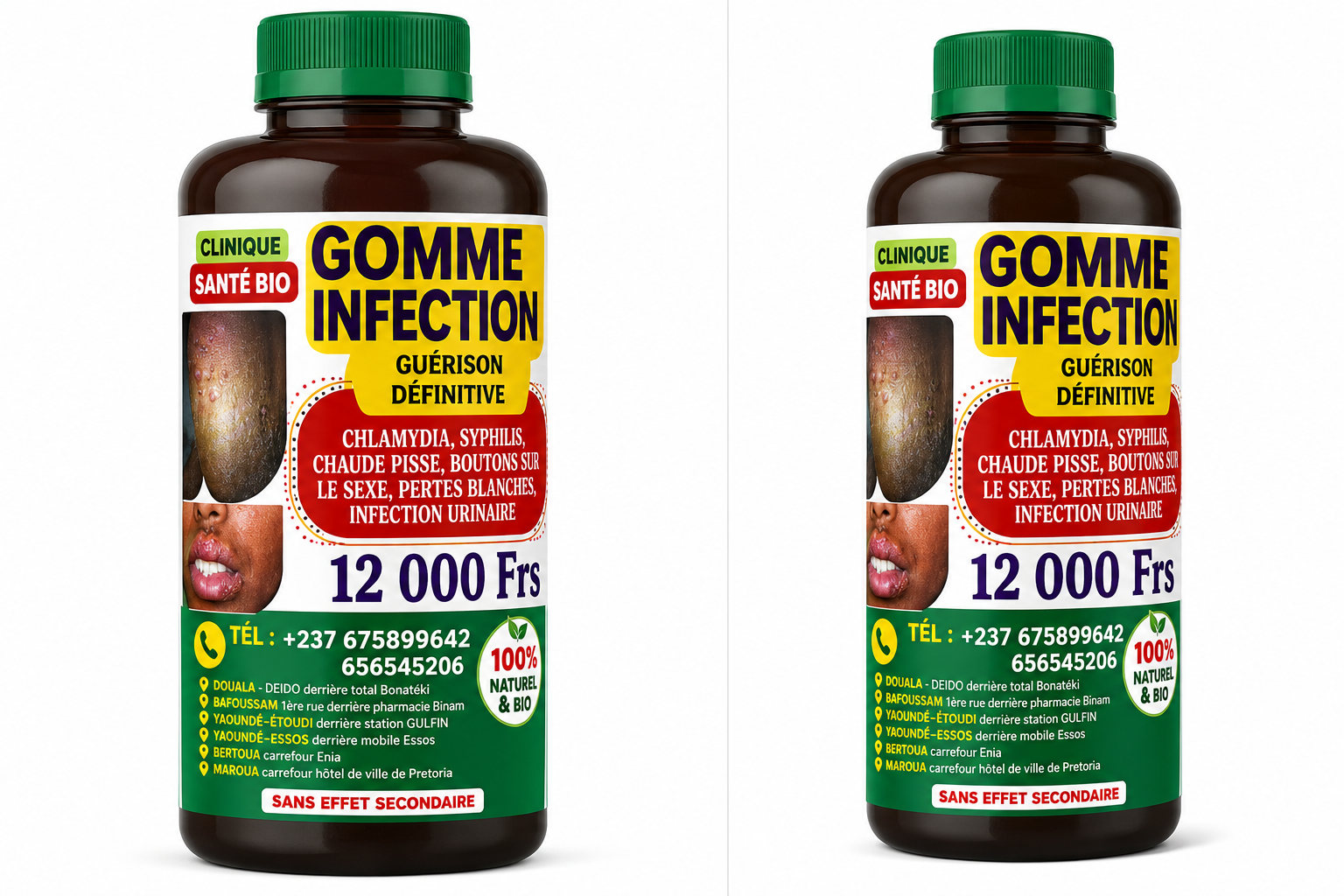 GOMME INFECTION